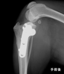 レントゲン 手術後