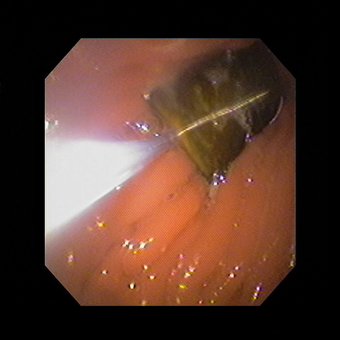 胃内異物の摘出画像画像