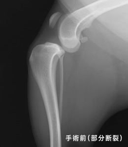レントゲン 手術前(部分断裂)